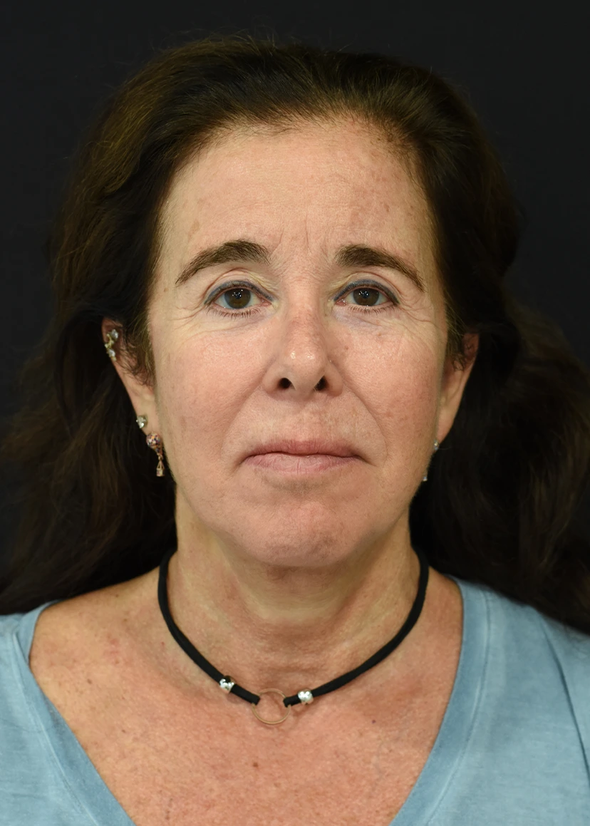 Deep Plane Facelift Patient 20 Set 1 After